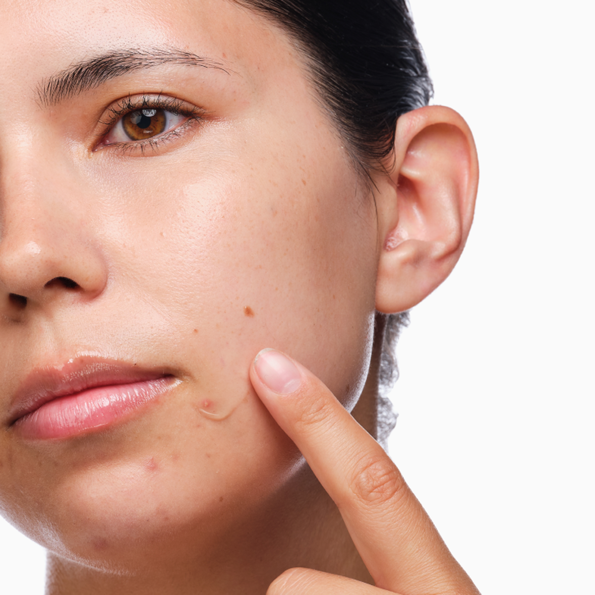 the-acne-set-i0 rdn-the-acne-set-application.png