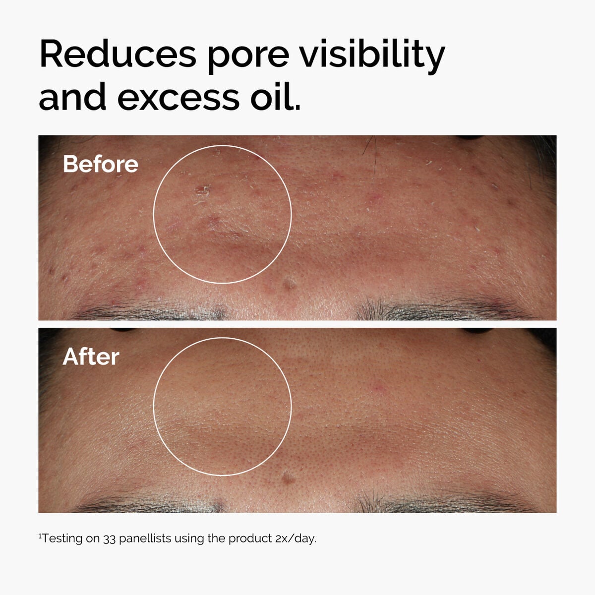 niacinamide-10-zinc-1-c8 ord-niacinamide-zinc-blemish-serum-before-after-pores.jpg