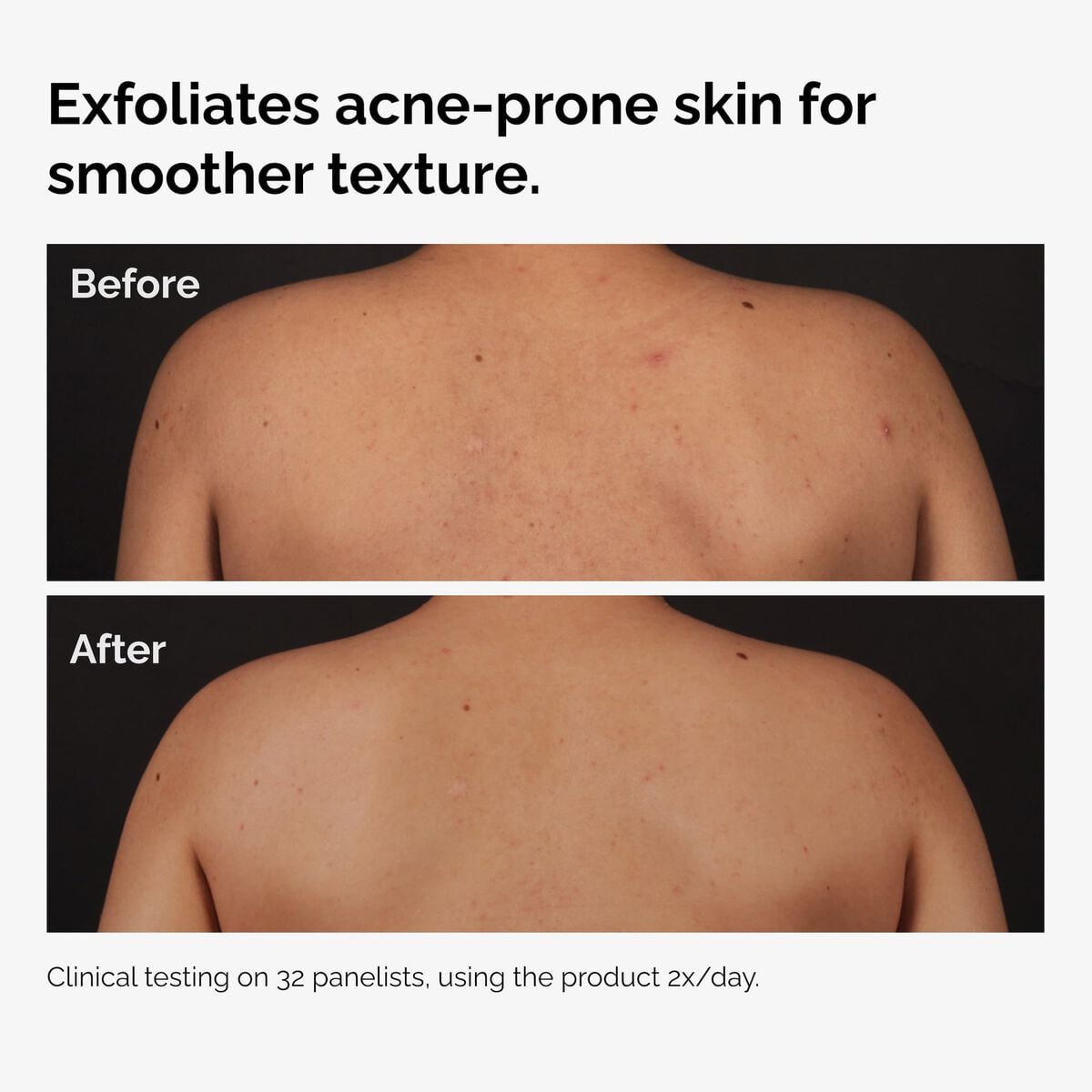 salicylic-acid-0-5-body-serum-p6 ord-salicylic-acid-body-serum-before-after-graphic-NA.jpg